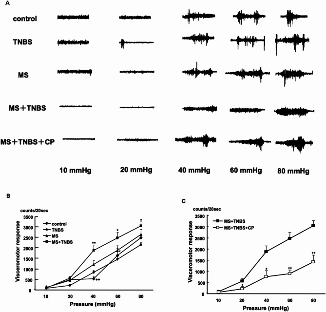 Corticotropin-releasing hormone receptor-1 antagonist attenuates visceral hypersensitivity induced by trinitrobenzene sulfonic acid colitis and maternal separation in rats.