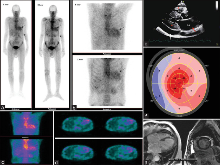Assessment of ATTR Cardiac Amyloidosis in Patients with Left Ventricular Hypertrophy Using Tc-99m Pyrophosphate Scintigraphy.