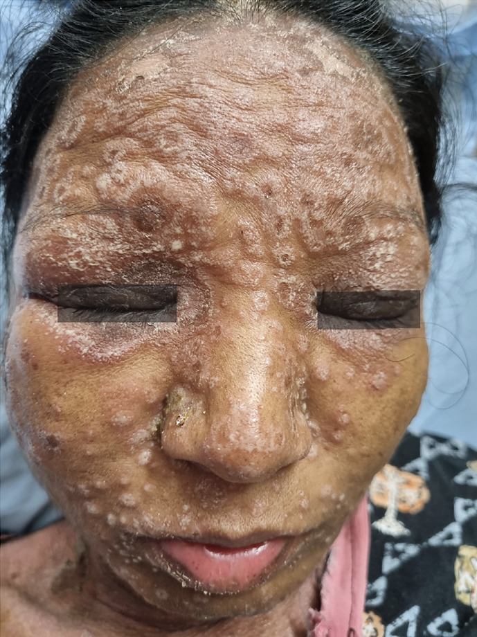 Pustular psoriasis of pregnancy with paradoxical facial involvement: an uncommon presentation-what is your diagnosis?