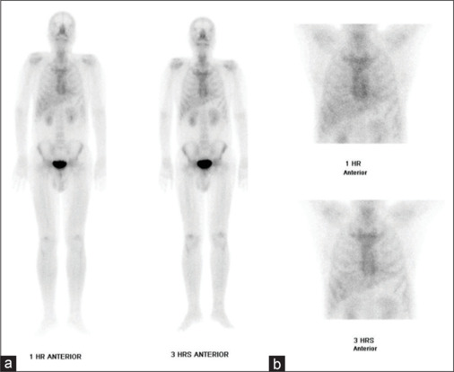 Assessment of ATTR Cardiac Amyloidosis in Patients with Left Ventricular Hypertrophy Using Tc-99m Pyrophosphate Scintigraphy.