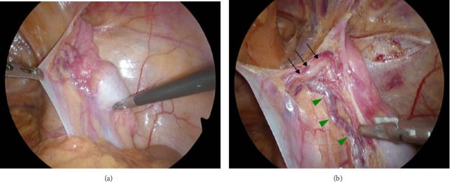 Incidental Discovery of Complications of Cryptorchidism During Laparoscopic Inguinal Hernia Surgery.