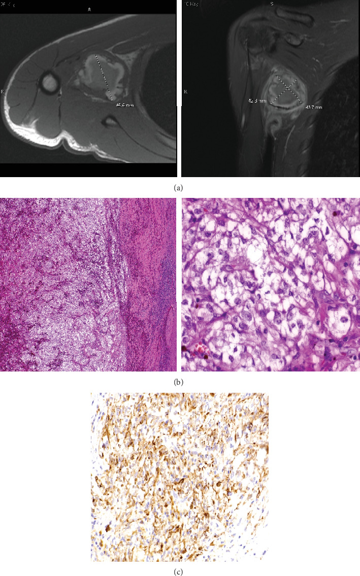 The Importance of Next-Generation Sequencing in Identifying Immunohistochemically Ambiguous Pediatric Sarcomas.