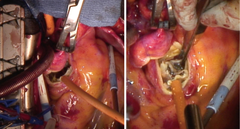 Transcatheter aortic valve replacement explantation experience in Japanese high-volume center.