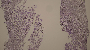 Synchronous Primary Malignancies: Incidental Detection of Ascending Colon Adenocarcinoma During Staging of Invasive Ductal Carcinoma of the Breast.
