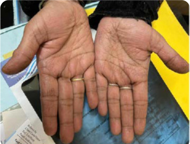 Prevalence of Anti-Synthetase Syndrome in Patients of Interstitial Lung Disease with Connective Tissue Diseases and Autoimmune Features: A Cross-Sectional Study.