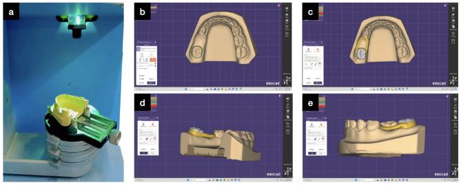 Conventional vs. 3D printed band and loop space maintainers: a fracture strength analysis.