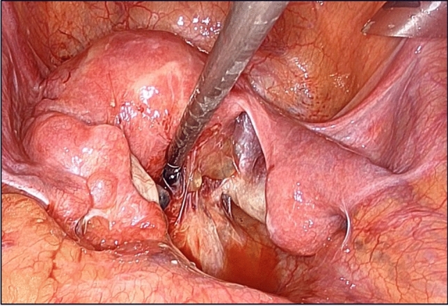 A proactive technique for reversal of Hartmann's procedure: lifting the rectal stump to the abdominal wall.