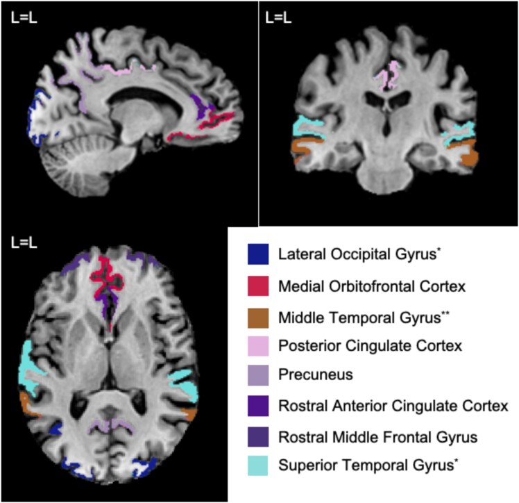 Brain structural magnetic resonance imaging predictors of brief intervention response in individuals with alcohol use disorder.