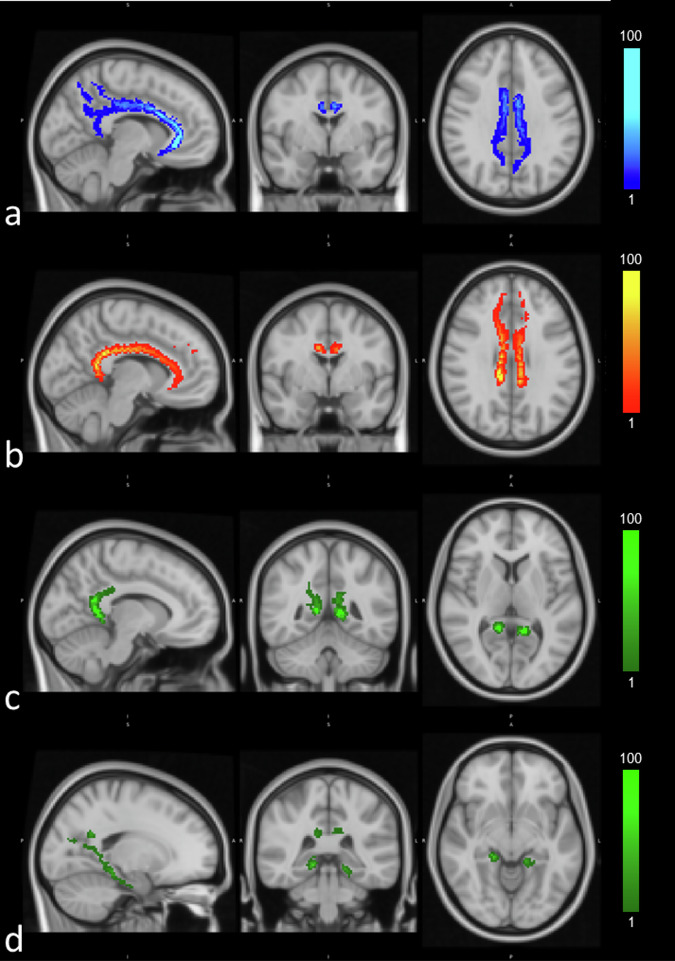Connectivity related to major brain functions in Alzheimer disease progression: microstructural properties of the cingulum bundle and its subdivision using diffusion-weighted MRI.