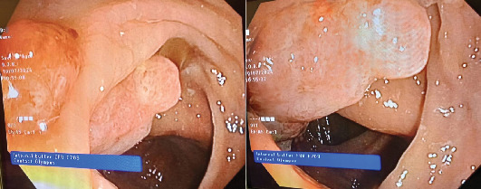 Synchronous Primary Malignancies: Incidental Detection of Ascending Colon Adenocarcinoma During Staging of Invasive Ductal Carcinoma of the Breast.