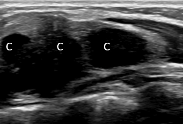 SELSTOC: Self‑Limiting Sternal Tumour of Childhood.