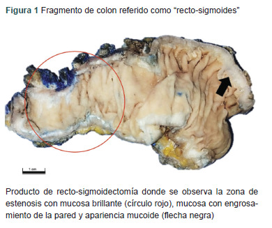 [Colitis cystica profunda induced by radiation 27 years later. Case report].