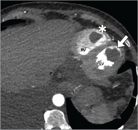 Effective Thrombectomy for Biventricular Thrombosis With an Endoscope via the Aortic and Tricuspid Heart Valves.