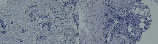 Synchronous Primary Malignancies: Incidental Detection of Ascending Colon Adenocarcinoma During Staging of Invasive Ductal Carcinoma of the Breast.
