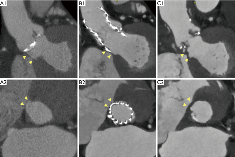 Transcatheter aortic valve replacement explantation experience in Japanese high-volume center.