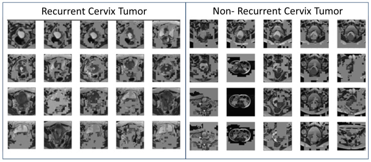 Discussion of a Simple Method to Generate Descriptive Images Using Predictive ResNet Model Weights and Feature Maps for Recurrent Cervix Cancer.