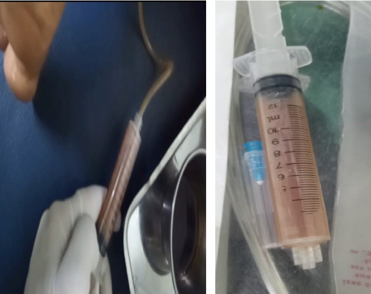 Ruptured Tubercular Baker's Cyst: A Case Report.