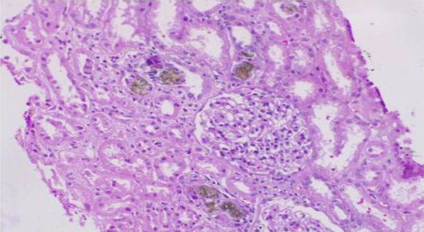 2,8-dihyroxyadenine (DHA) crystalline nephropathy: A case report.