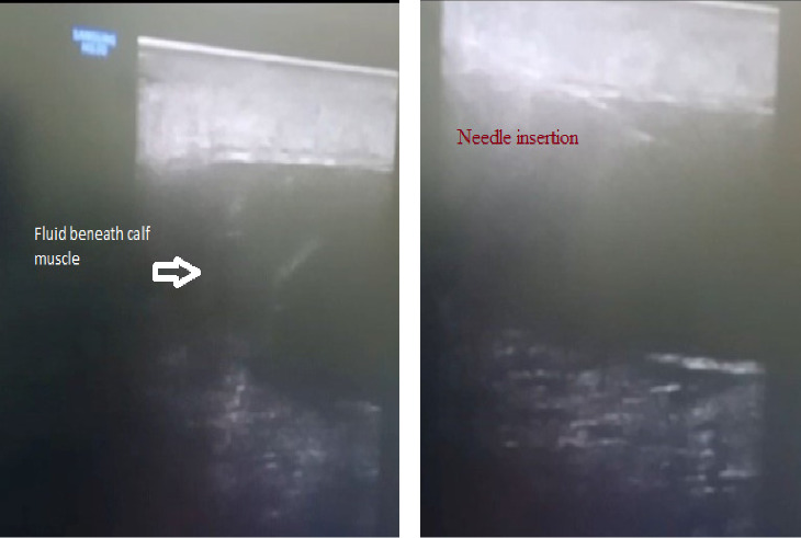 Ruptured Tubercular Baker's Cyst: A Case Report.