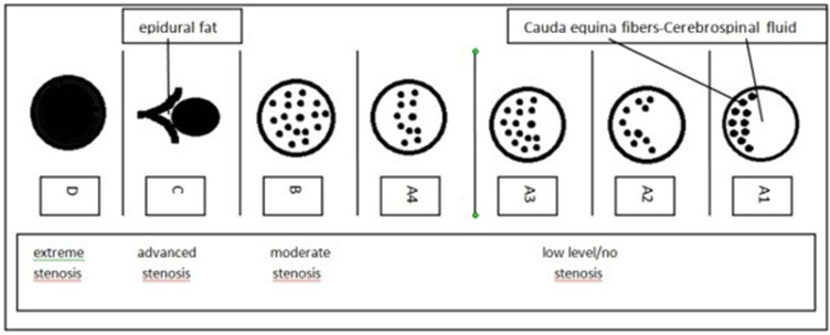 A PEEK Rod-Based Dynamic Instrumentation Construct for the Degenerative Lumbar Spine Disease, First Appraisal Based on Five-year Clinical and Radiological Findings.