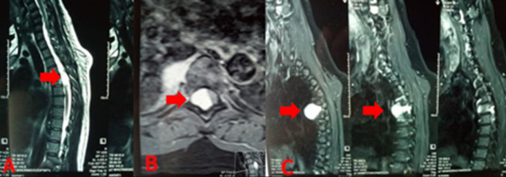 Thoracic cavernous hemangioma mimicking an epidural neurinoma in an hourglass shape: a case report and review of the literature.