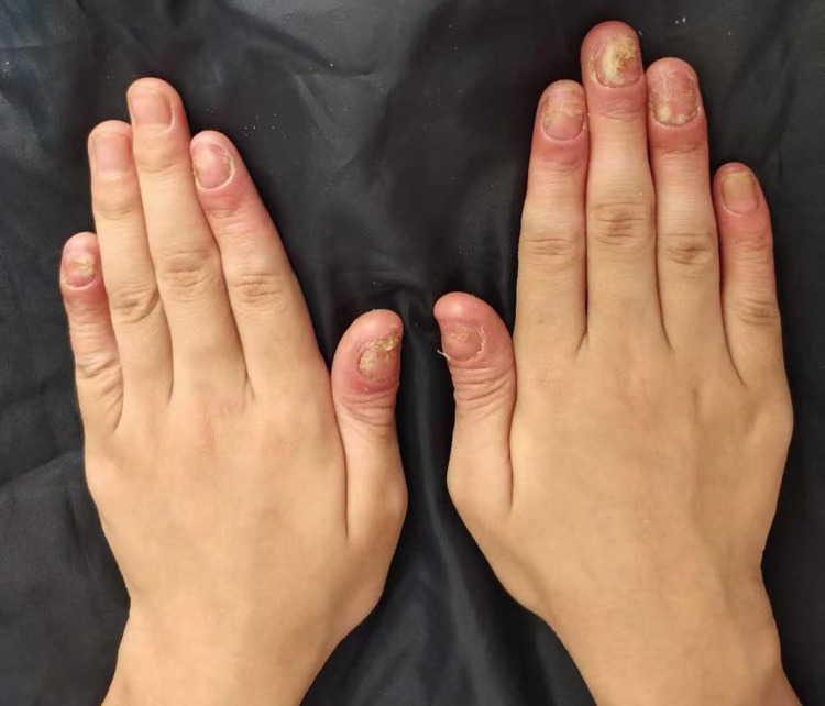 Acrodermatitis Continua of Hallopeau and Generalised Pustular Psoriasis: Case Reports of Two Different Manifestations of IL36RN Mutation in Siblings.