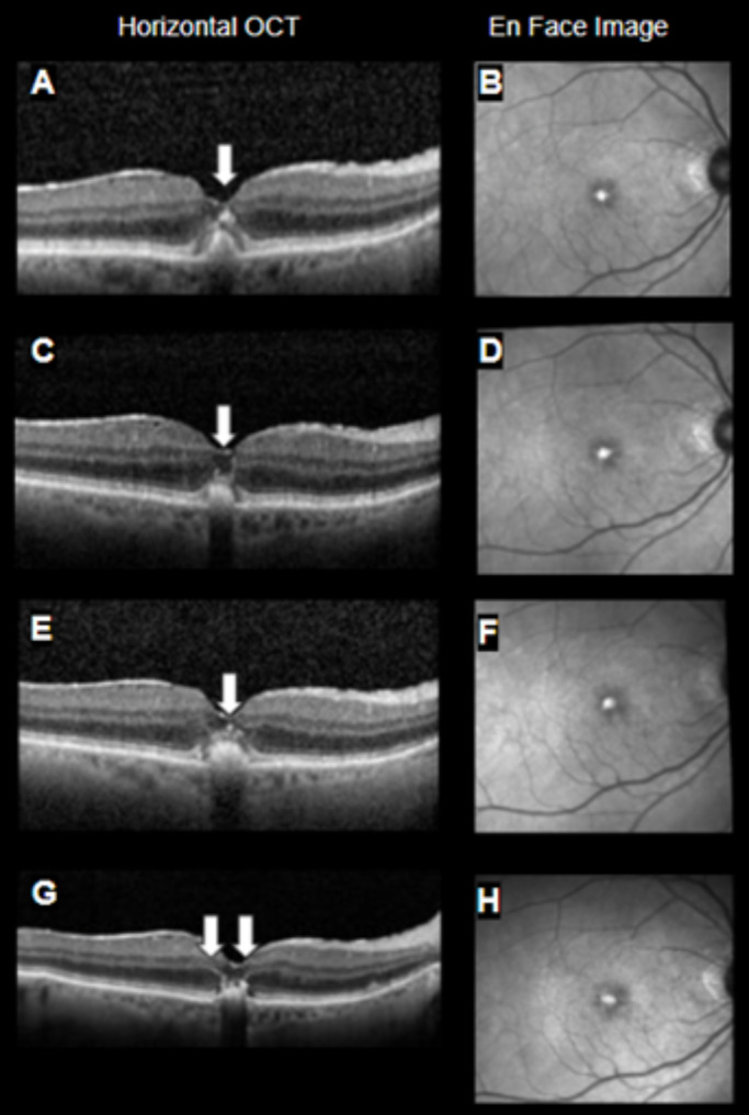 Foveal crack sign and macular pattern dystrophy.