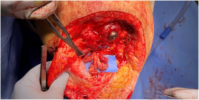Changes in pain and prosthesis wear following transfemoral osseointegration combined with sciatic nerve RPNI.
