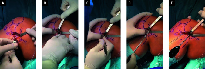Functional outcomes of simultaneous anterior cruciate ligament reconstruction and lateral extra-articular tenodesis using an all-suture anchor: a modified mini-open technique.