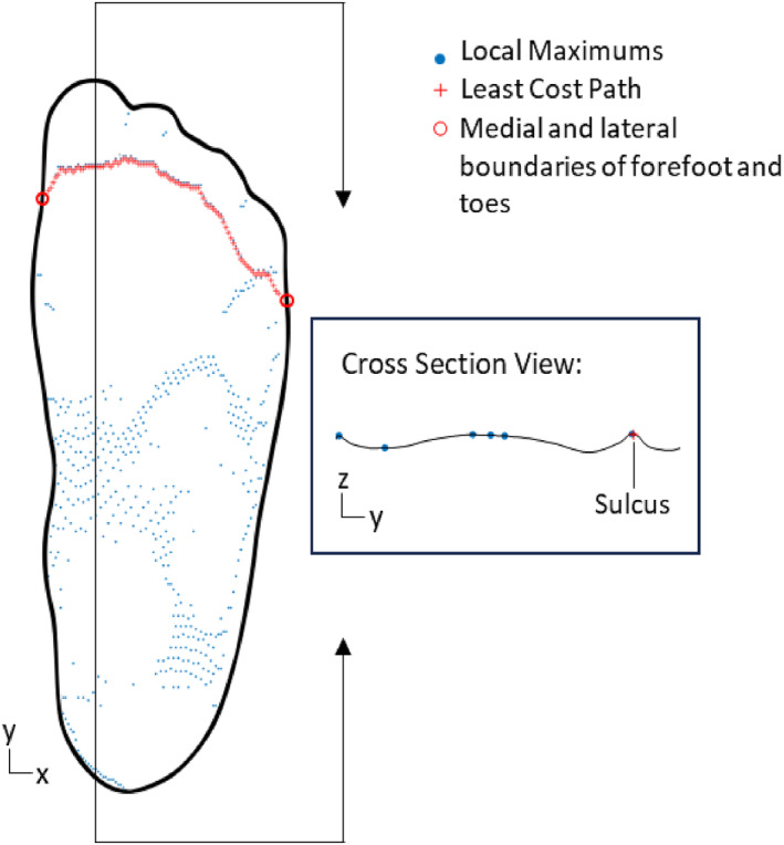 Three-dimensional differences in plantar surface shape captured by methods used for custom accommodative insole design.