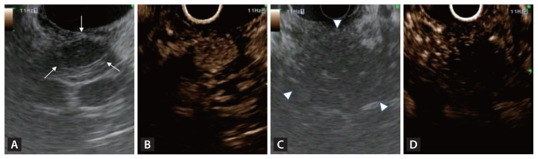 Role of endoscopic ultrasound in the diagnosis and local ablative therapy of pancreatic neuroendocrine tumors.