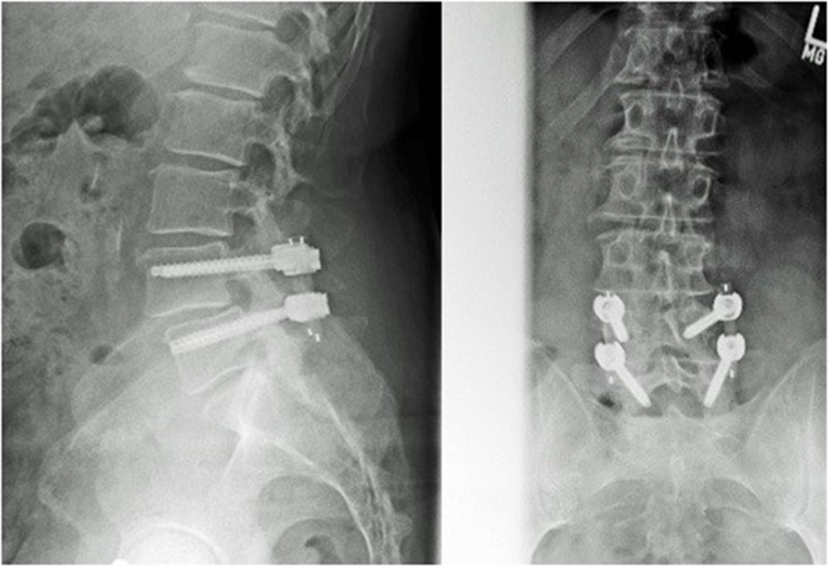 A PEEK Rod-Based Dynamic Instrumentation Construct for the Degenerative Lumbar Spine Disease, First Appraisal Based on Five-year Clinical and Radiological Findings.