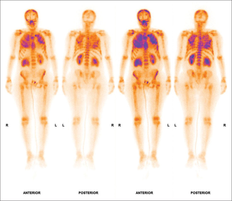 Diffuse Pulmonary <sup>99m</sup>Tc-MDP Uptake on Bone Scintigraphy: A Paraneoplastic Hypercalcemia Clue in Cervical Carcinoma.