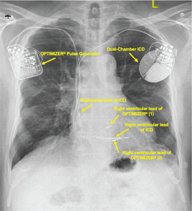 "Optimizing" the Anesthetic for Cardiac Contractility Modulation Devices.
