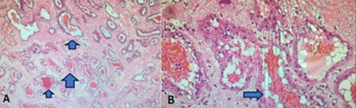 Thoracic cavernous hemangioma mimicking an epidural neurinoma in an hourglass shape: a case report and review of the literature.
