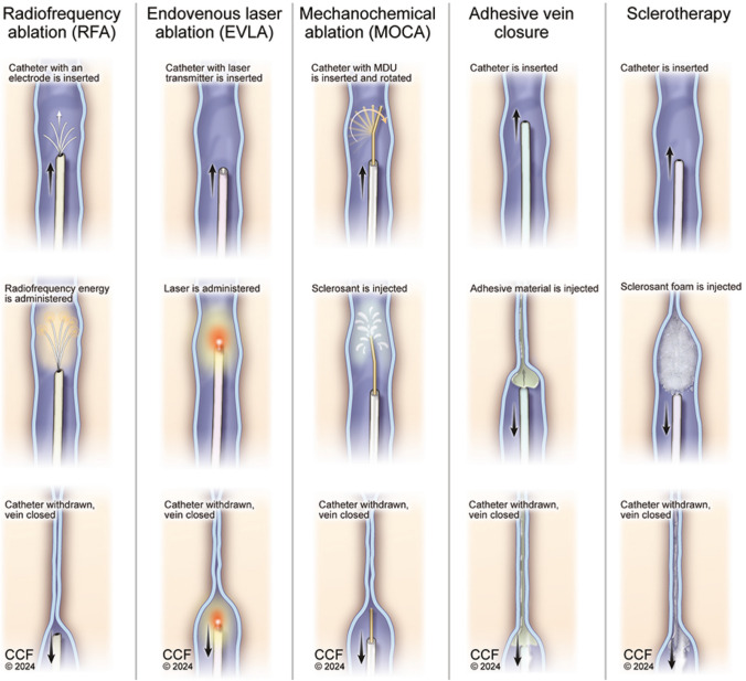 Venous Insufficiency: Endovascular and Surgical Treatment.