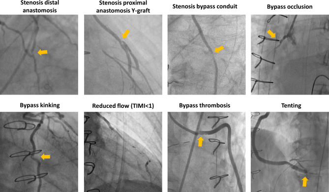 Symptomatic early coronary graft failure in bypass surgery patients: incidence, predictors and clinical impact.