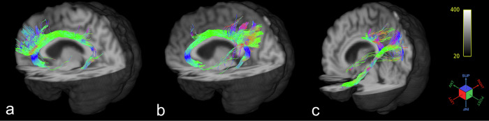 Connectivity related to major brain functions in Alzheimer disease progression: microstructural properties of the cingulum bundle and its subdivision using diffusion-weighted MRI.