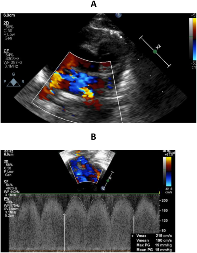 Serial echocardiography in preterm infants with bronchopulmonary dysplasia: diagnosing and managing recurrent pulmonary vein stenosis.