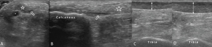 Ultrasound Imaging and Guidance for Tamoxifen-Associated Achilles Tendinopathy.