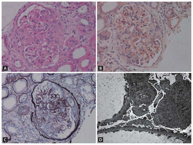 Renal recovery from membranous lupus nephritis with antineutrophil cytoplasmic antibody-associated glomerulonephritis with belimumab.