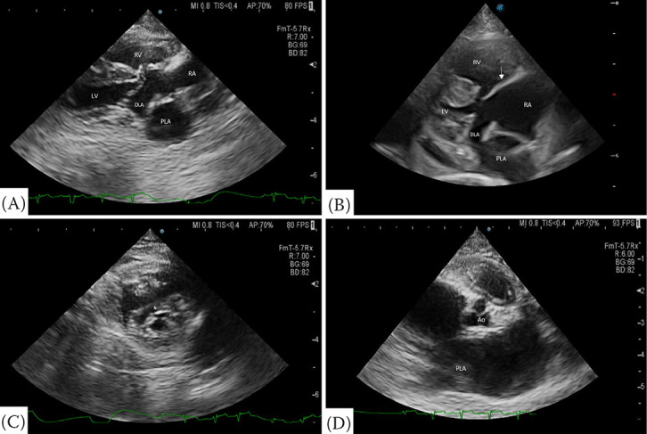 Cor triatriatum sinister with partial atrioventricular septal defect in a cat.