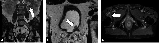 Additional findings in prostate MRI.