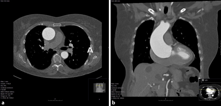 Sudden onset chest pain after a CT-scan of the aorta.