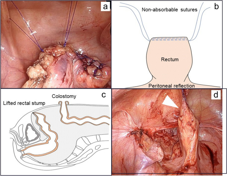A proactive technique for reversal of Hartmann's procedure: lifting the rectal stump to the abdominal wall.