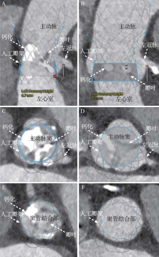 [Risk of coronary obstruction and protection strategies in transcatheter aortic valve replacement].