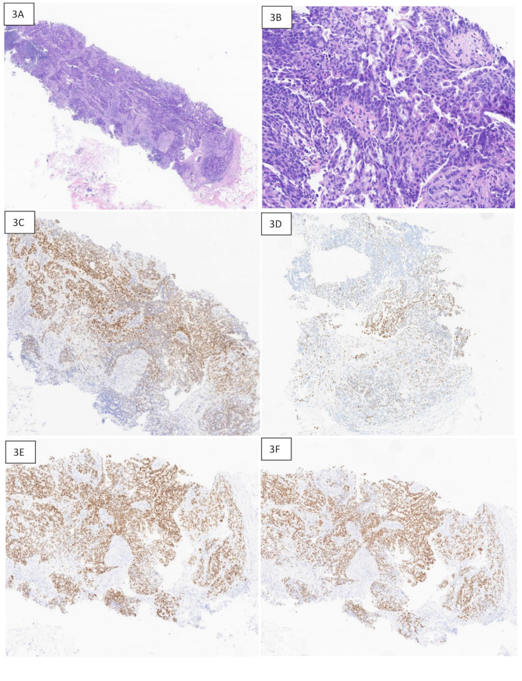 Trichorhinophalangeal syndrome type 1 (TRPS1) in breast pathology: diagnostic utility and pitfalls.