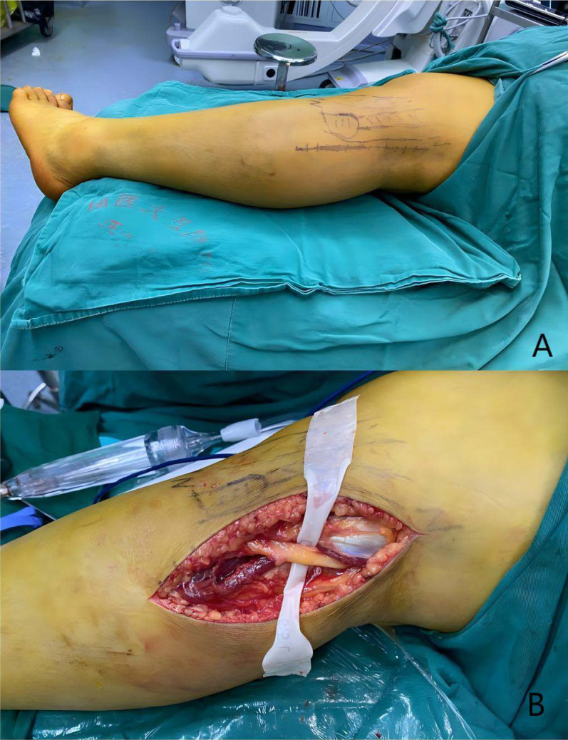 Fibular head osteotomy: A new technique for better exposure of postero-lateral tibial plateau fracture.