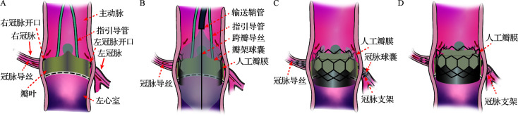 [Risk of coronary obstruction and protection strategies in transcatheter aortic valve replacement].