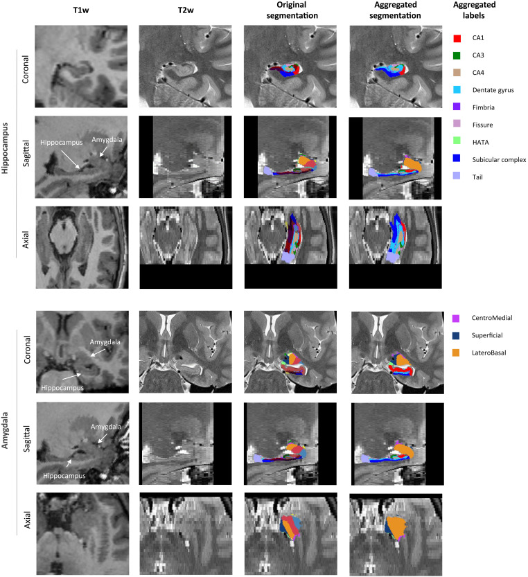 Linking birth experience and perinatal depression symptoms to neuroanatomical changes in hippocampus and amygdala.